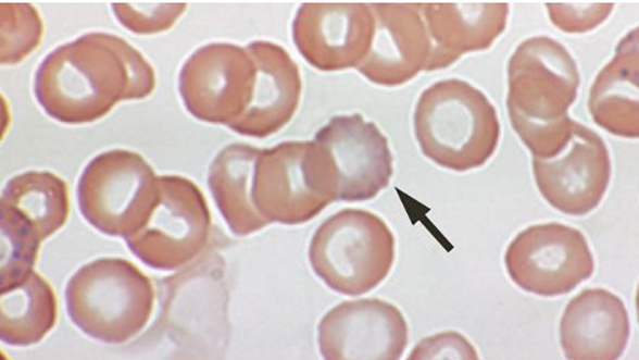 microscopic view of lead poisoning